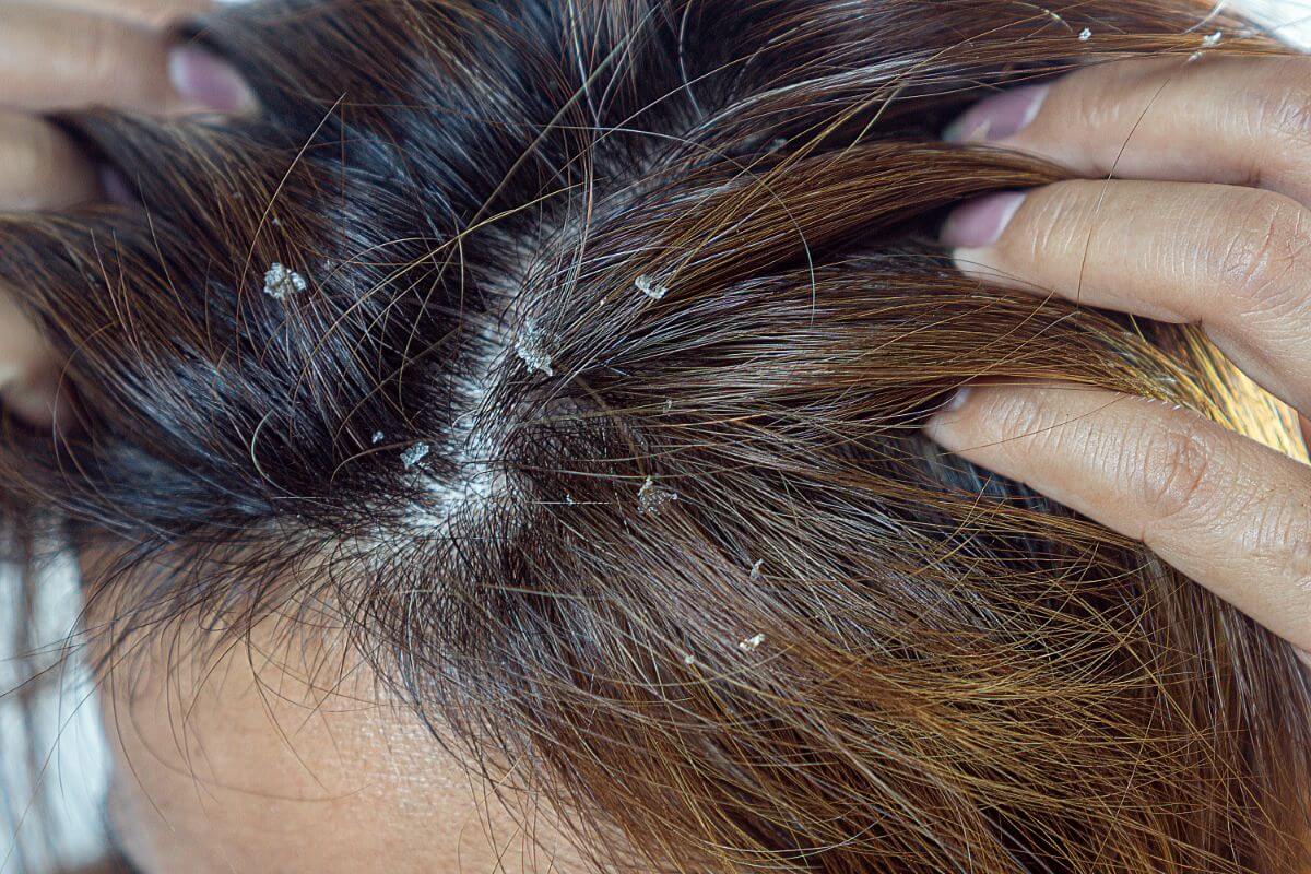 meilleur shampoing pour cuir chevelu irrité