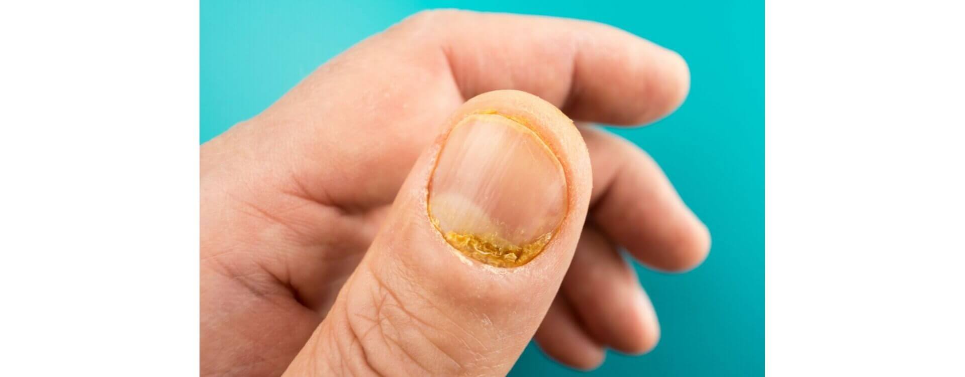 Comment soigner une mycose de l'ongle (main, pied) ?